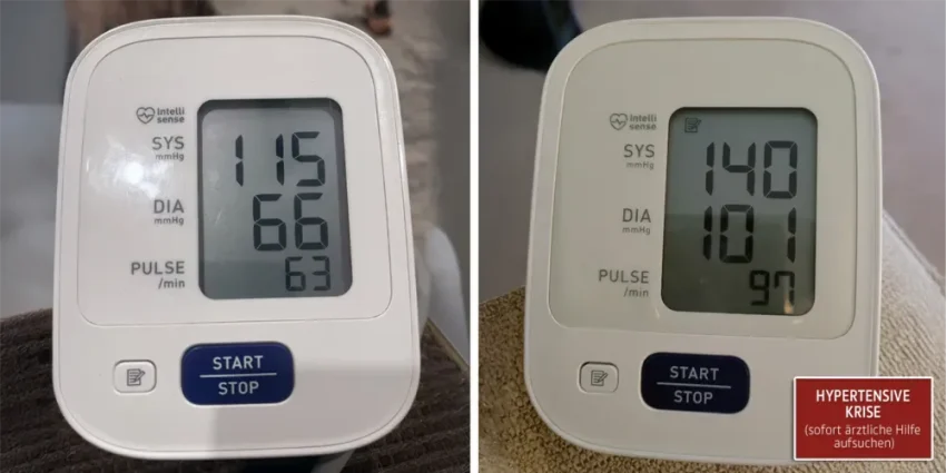 sleep-apnea-hypertensive-crisis